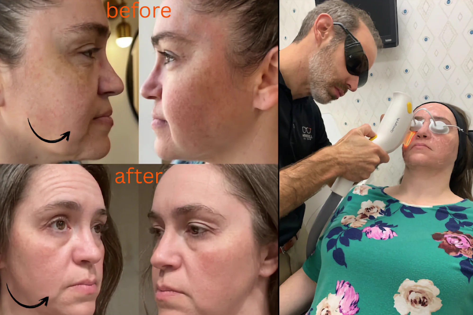 A four-panel before and after montage of a female patient's facial skin treatment results, next to Dr. Lutz performing an IPL procedure on the patient.
